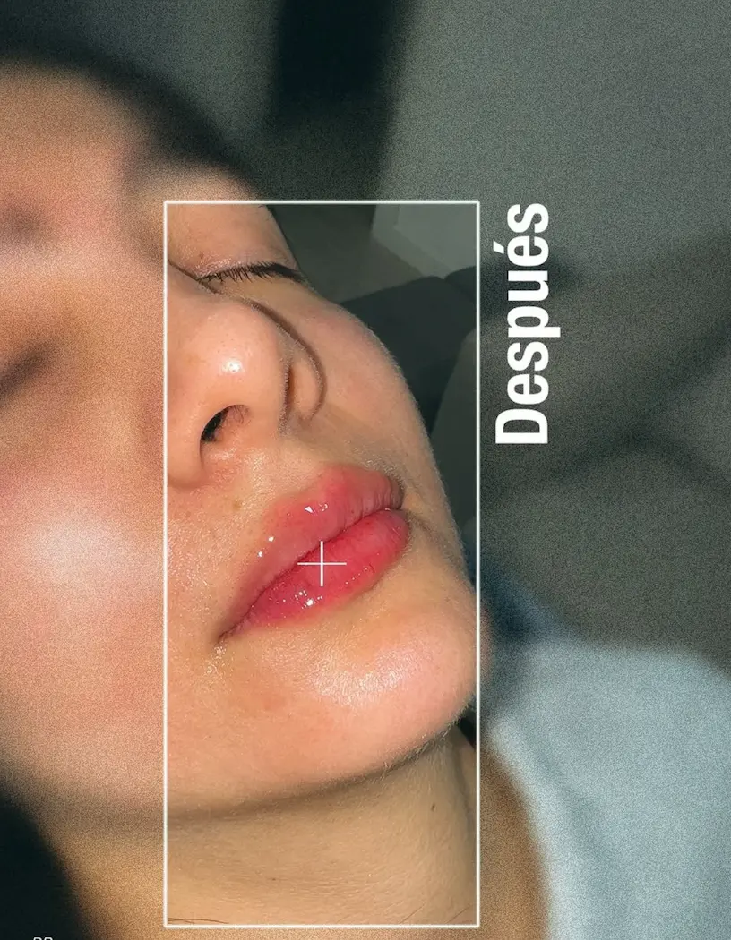 Aumento de labios con ácido hialurónico, después