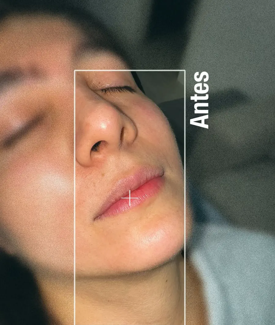 Aumento de labios con ácido hialurónico, antes