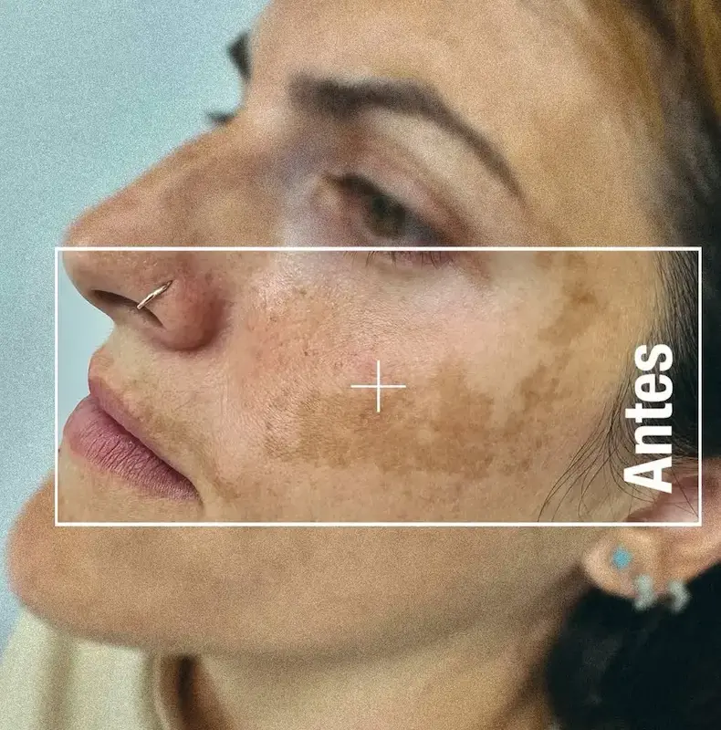 melasma