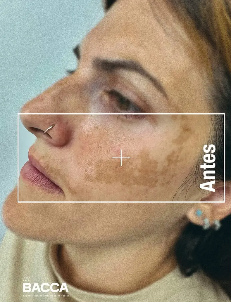 Mesoterapia, skinbooster y peelings - Dr. Santiago Bacca