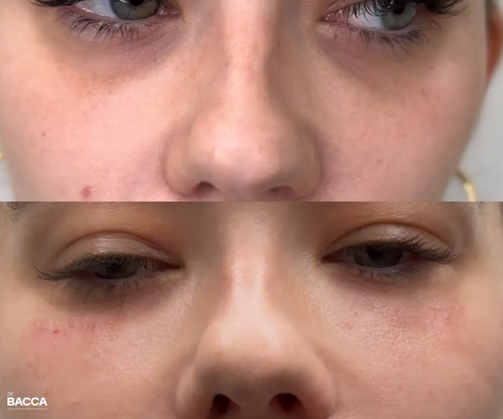 Ácido hialurónico para ojeras: cómo funciona y a quién le conviene