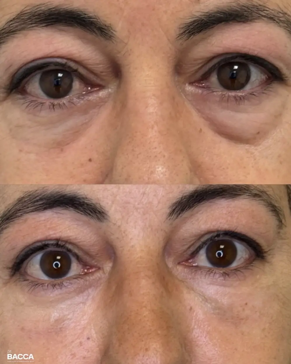 Ojeras rellenadas con ácido hialurónico, antes y después