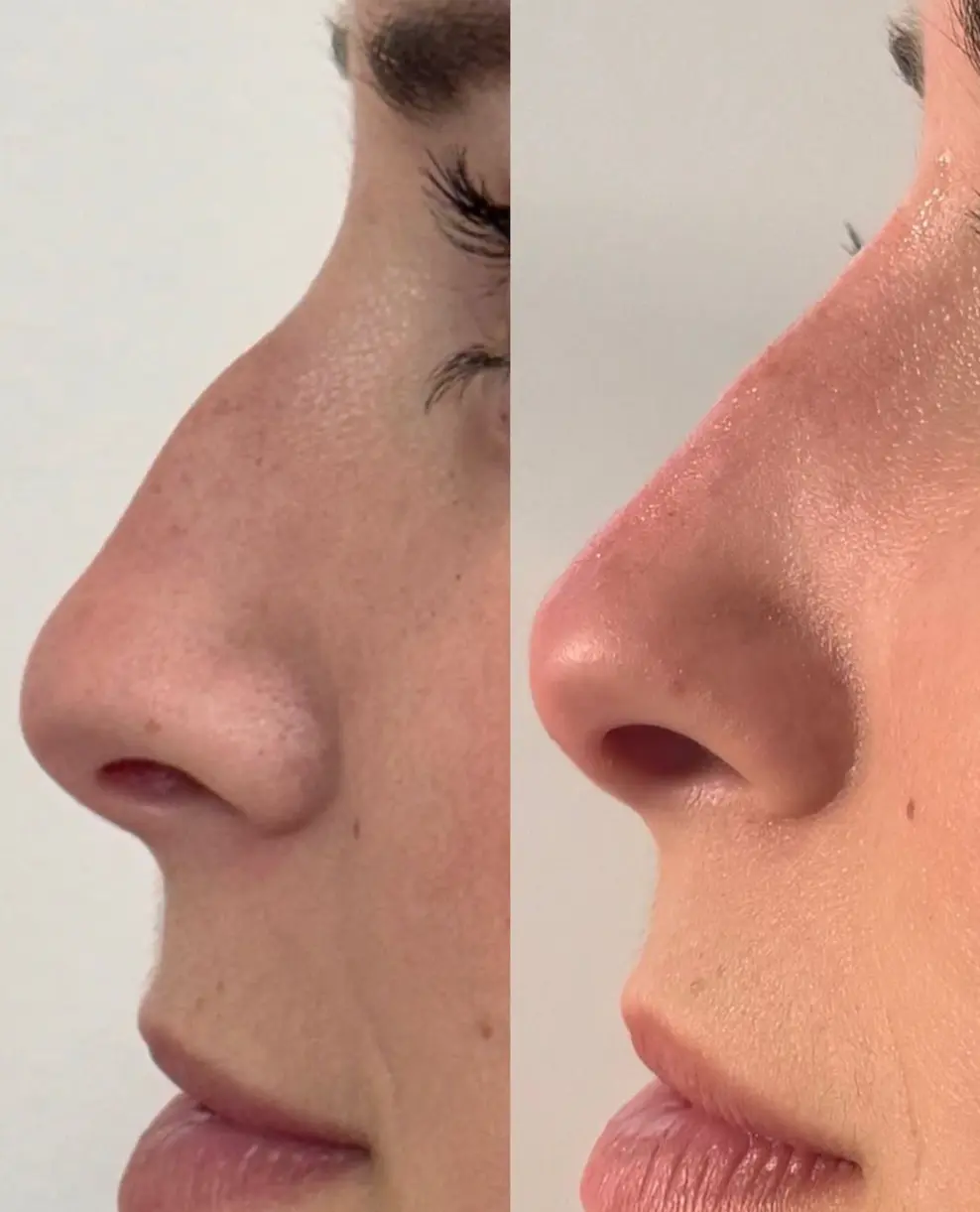Armonización facial - Dr. Santiago Bacca